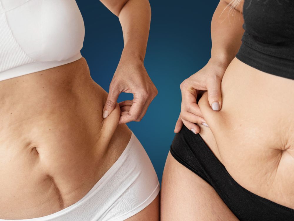 Flacidez: Entenda as Causas e Saiba Como Preveni-lá