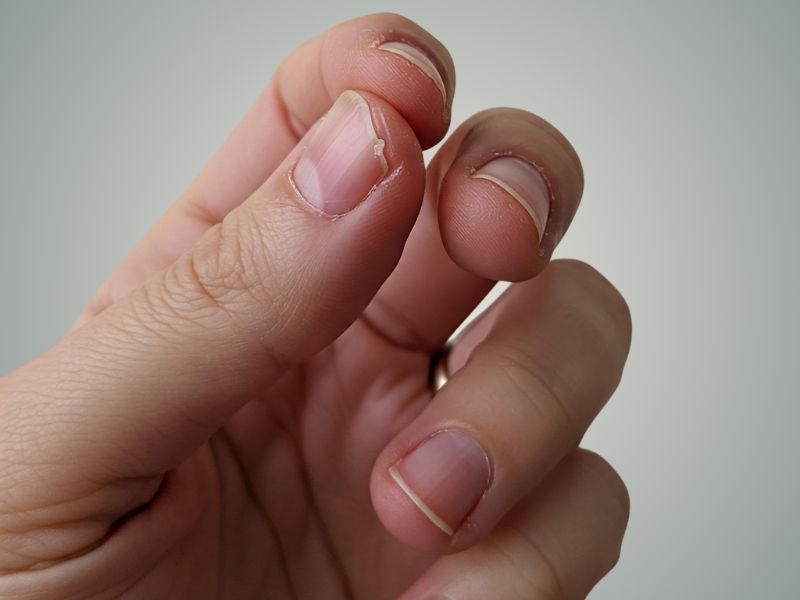 Unhas frágeis são aquelas que se descamam, racham ou quebram com facilidade, mesmo com pequenos impactos